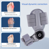 Chic Charm Upgraded Adjustable Bunion Corrector Support